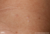 molluscum contagiosum