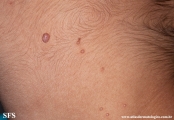 molluscum contagiosum