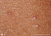 molluscum contagiosum