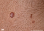 molluscum contagiosum